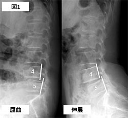 症 腰椎 すべり